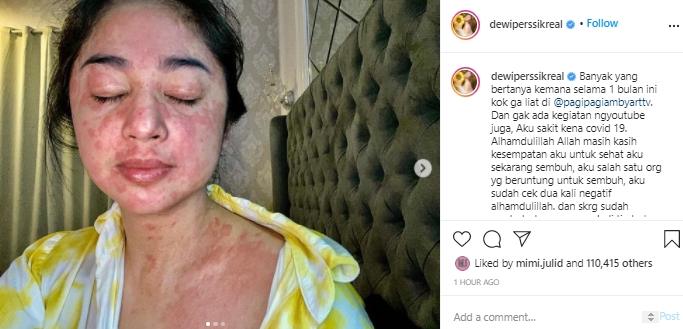 Terpapar Covid-19, Wajah dan Tubuh Dewi Perssik Penuh Bercak Merah Dewi Perssik tunjukan badan penuh bercak merah (Instagram.com/dewiperssikreal)