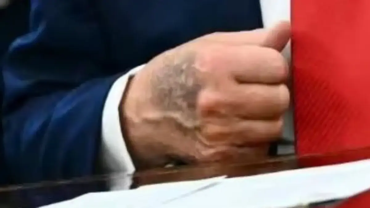 Beredar Foto Memar di Tangan Kiri Donald Trump Picu Spekulasi, Ini Tanggapan Gedung Putih Salah satu tangan Presiden AS Donald Trump terlihat memar di Davos, Swiss. (Foto: Daily Express US)