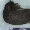 Penampakan gumpalan rambut. (Foto: Journal of Medical Case Reports)