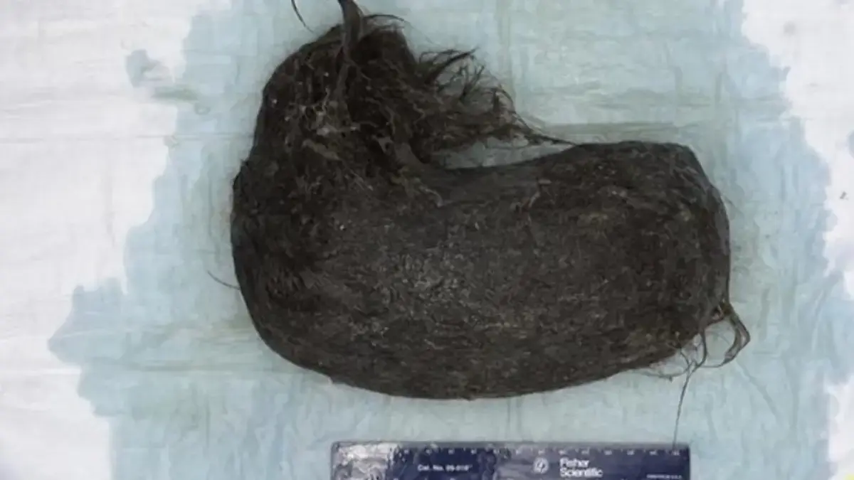 Penampakan gumpalan rambut. (Foto: Journal of Medical Case Reports)
